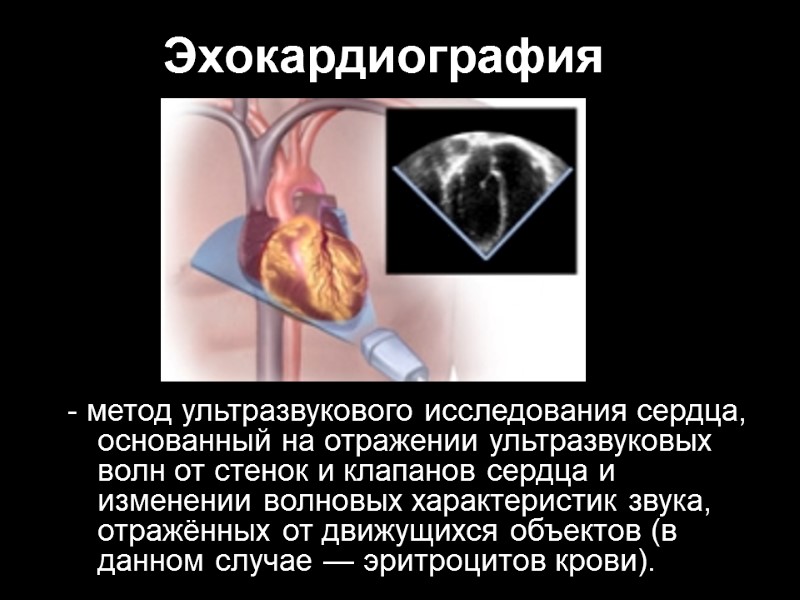Эхокардиография - метод ультразвукового исследования сердца, основанный на отражении ультразвуковых волн от стенок и